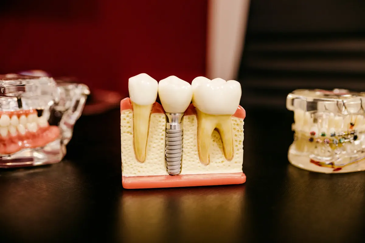Kron ve implant modelleri