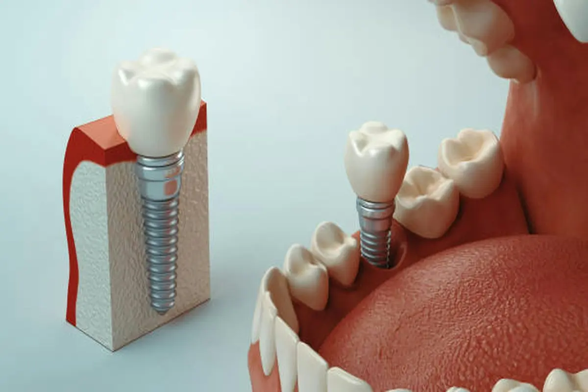 Çene kemiğindeki implant vidası ve kronu gösteren model